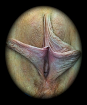 labioplastyka 